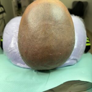 Micropigmentación capilar