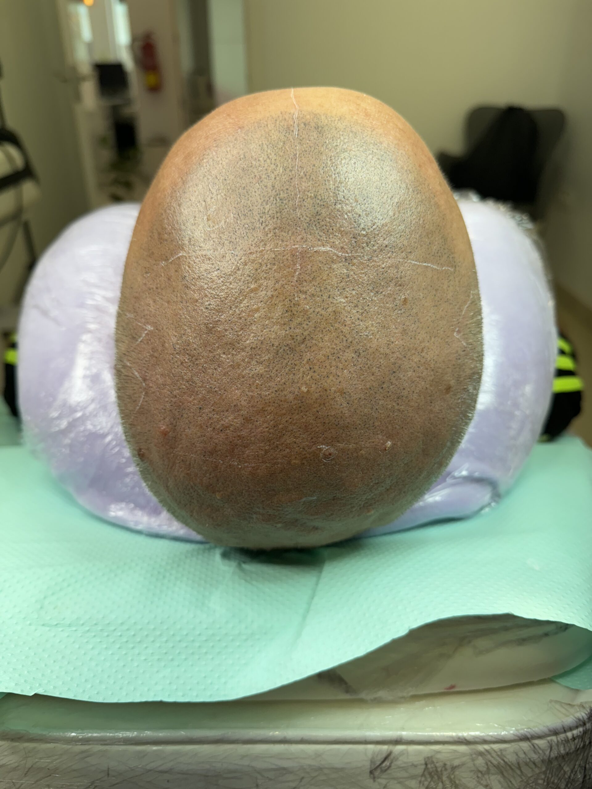 Micropigmentación capilar