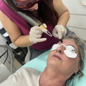 Laser Eliminacion de Micropigmentacion