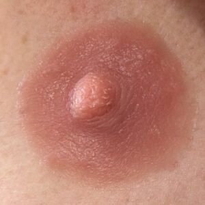 Protesis externas hiperrealistas de areola y pezón